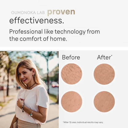 ForeverSmooth IPL Pro – Permanent Hair Removal Made Simple